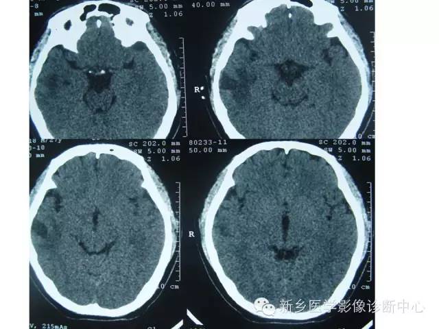 【病例】节细胞胶质瘤1例CT MR影像表现与鉴别