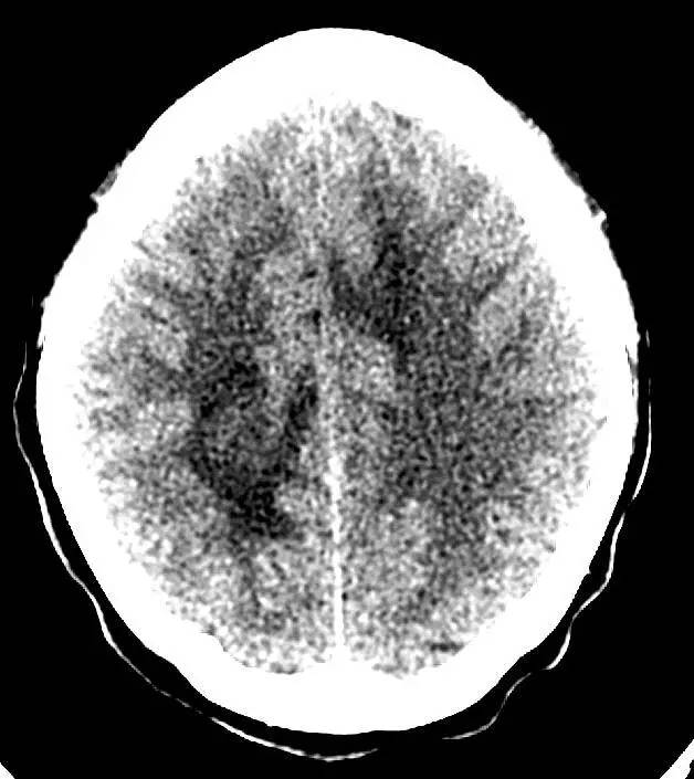 【病例】多发性硬化1例CT及MR影像表现