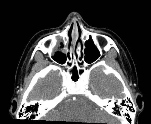 【病例】右上眼睑和眼球间木片存留1例CT影像表现