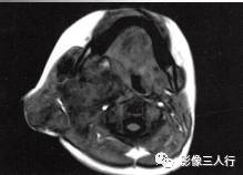 【病例】颈部淋巴管瘤1例MR影像表现分析
