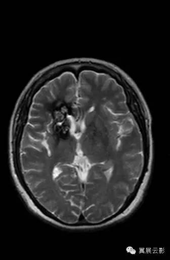【病例】右侧基底节区海绵状血管瘤1例MR影像表现