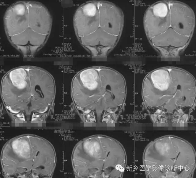 【病例】血管周围细胞瘤1例CT MR影像表现
