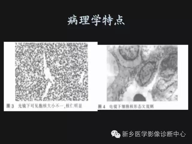 【病例】血管周围细胞瘤1例CT MR影像表现