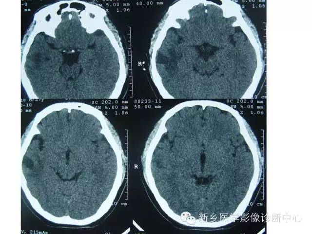 【病例】节细胞胶质瘤1例影像表现与鉴别