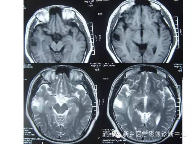 【病例】节细胞胶质瘤1例影像表现与鉴别