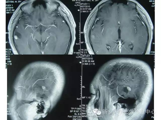 【病例】节细胞胶质瘤1例影像表现与鉴别