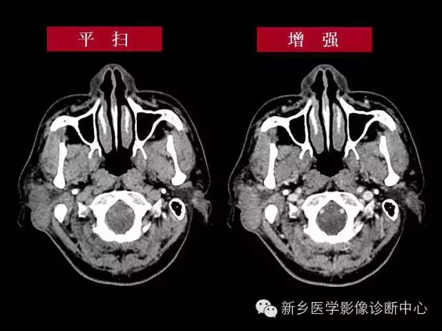 【病例】木村病1例CT影像表现与鉴别