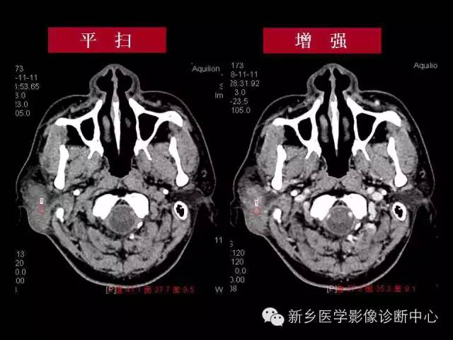 【病例】木村病1例CT影像表现与鉴别