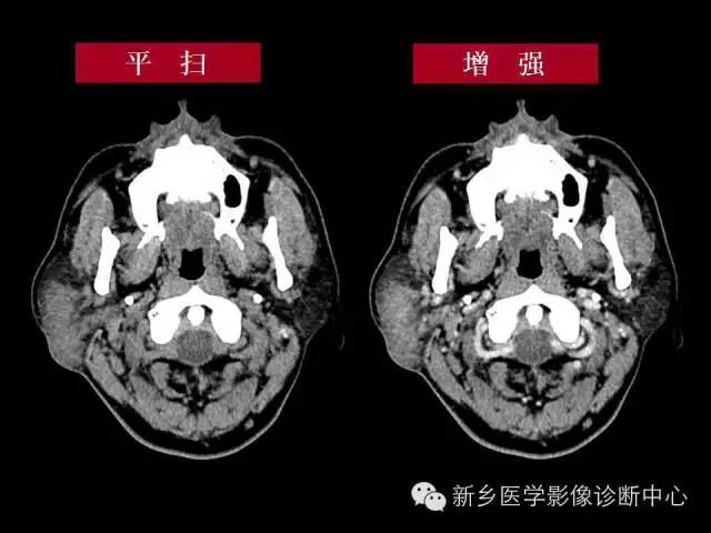 【病例】木村病1例CT影像表现与鉴别