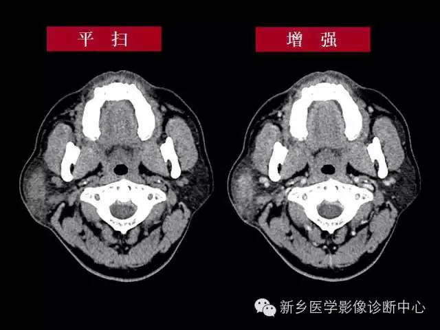 【病例】木村病1例CT影像表现与鉴别