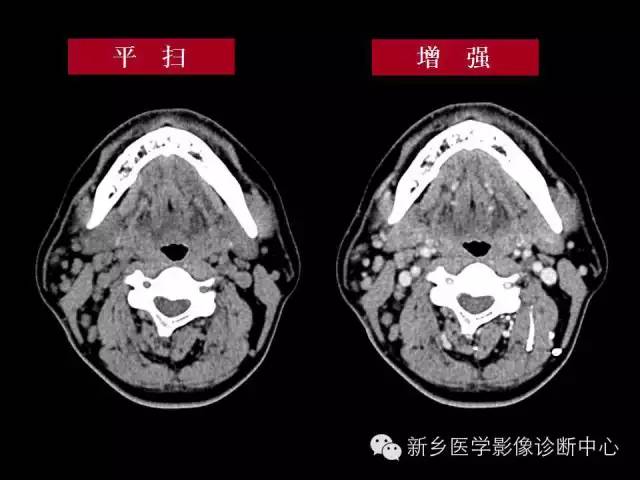 【病例】木村病1例CT影像表现与鉴别