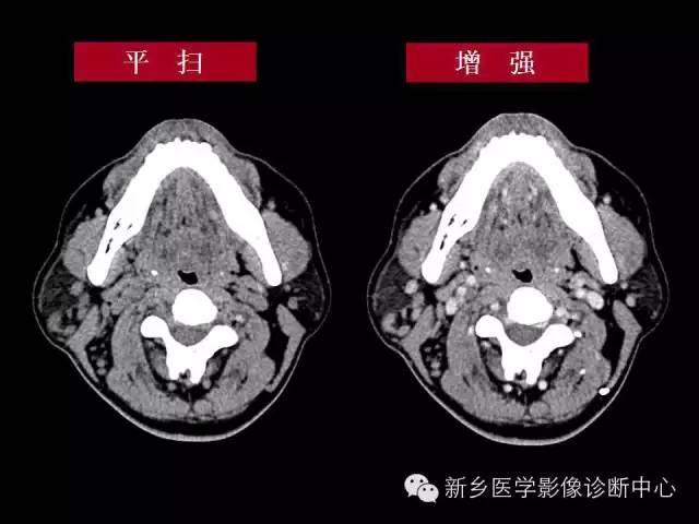 【病例】木村病1例CT影像表现与鉴别