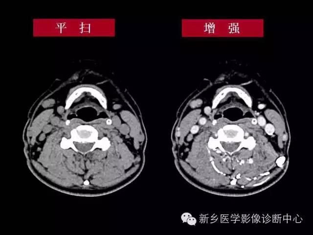 【病例】木村病1例CT影像表现与鉴别