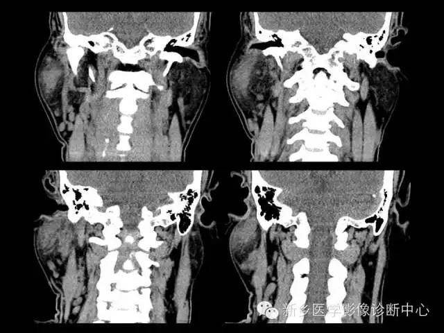 【病例】木村病1例CT影像表现与鉴别
