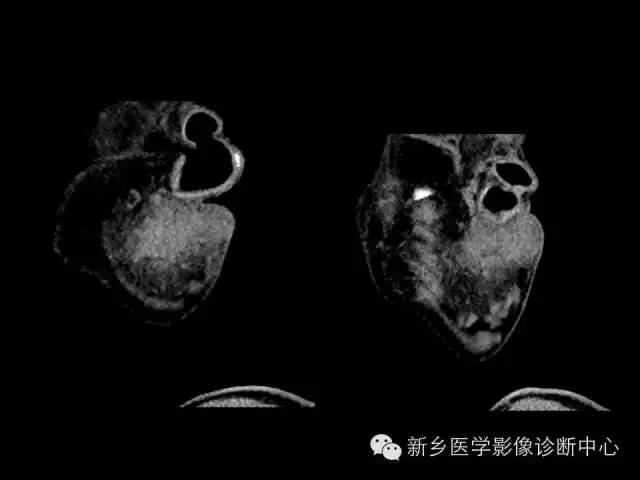 【病例】木村病1例CT影像表现与鉴别