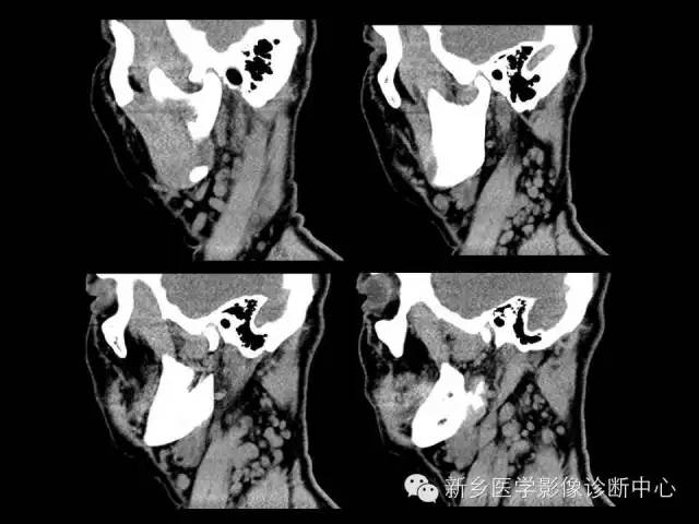 【病例】木村病1例CT影像表现与鉴别
