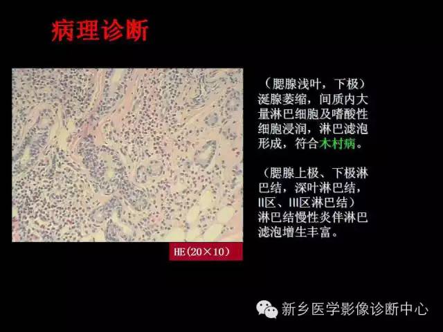 【病例】木村病1例CT影像表现与鉴别