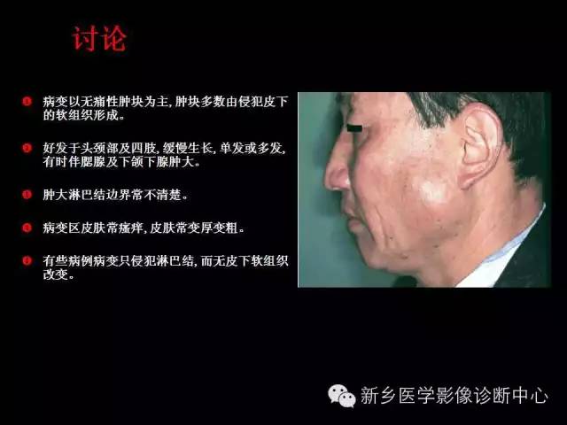 【病例】木村病1例CT影像表现与鉴别