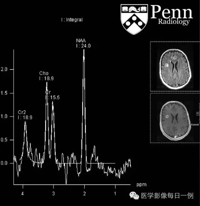 【病例】发育性静脉异常相关非特异性信号异常1例