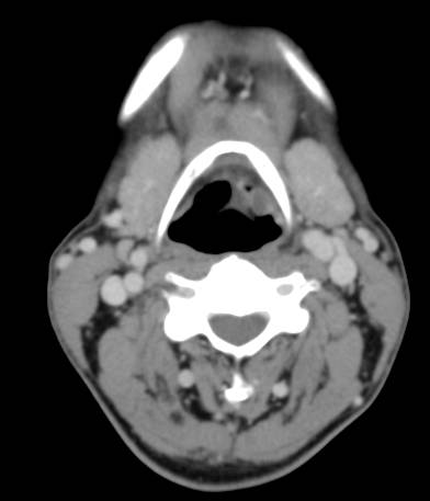 【病例】会厌结核1例CT影像表现