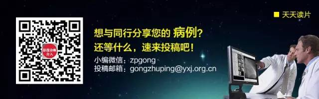 【病例】会厌结核1例CT影像表现