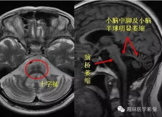 十大典型的神经影像学征象