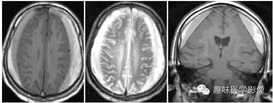 十大典型的神经影像学征象