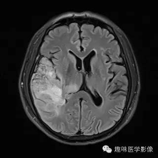 【病例】少突胶质细胞瘤1例MR影像表现
