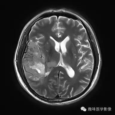 【病例】少突胶质细胞瘤1例MR影像表现