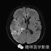 【病例】少突胶质细胞瘤1例MR影像表现