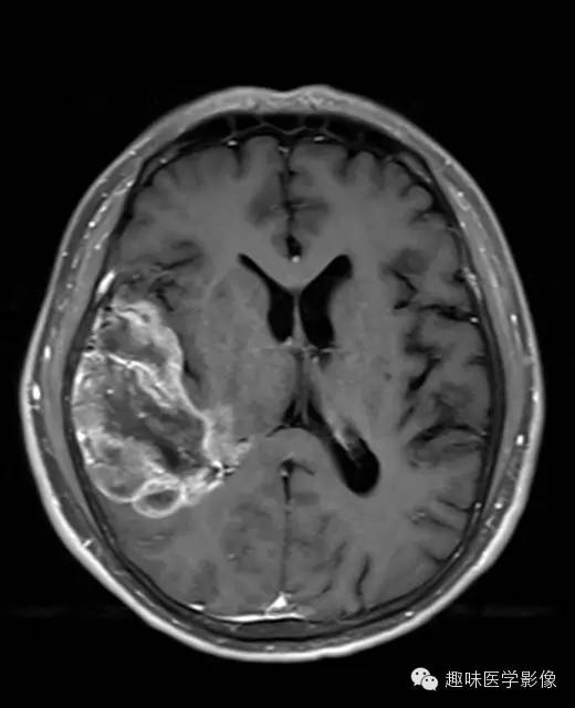 【病例】少突胶质细胞瘤1例MR影像表现