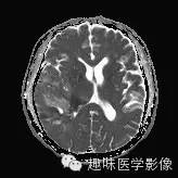 【病例】少突胶质细胞瘤1例MR影像表现
