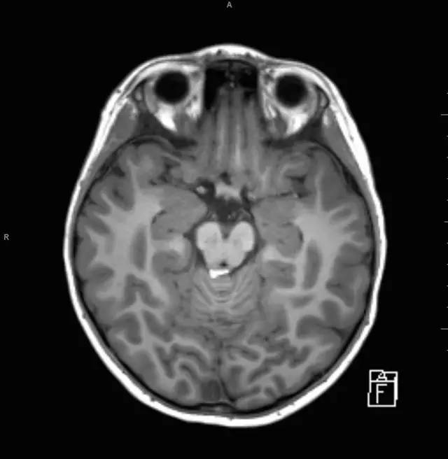 【病例】小儿颅内脂肪瘤一例MR影像表现
