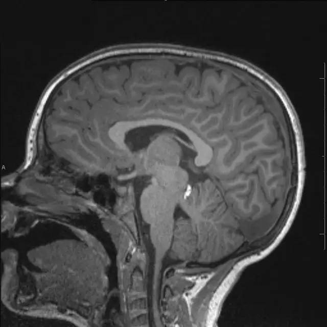 【病例】小儿颅内脂肪瘤一例MR影像表现