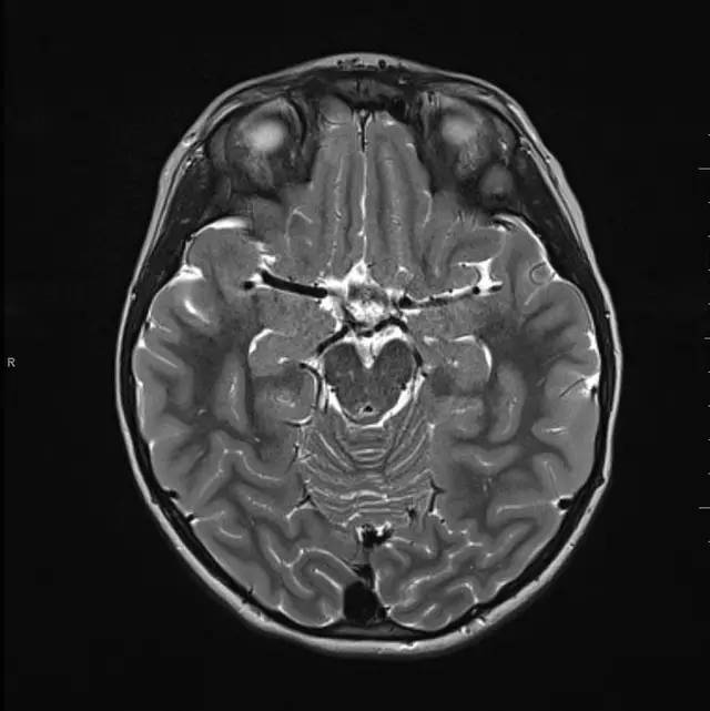【病例】小儿颅内脂肪瘤一例MR影像表现
