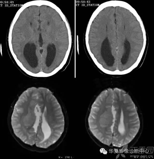 医学影像征象--解析汇集（神经系统部分）