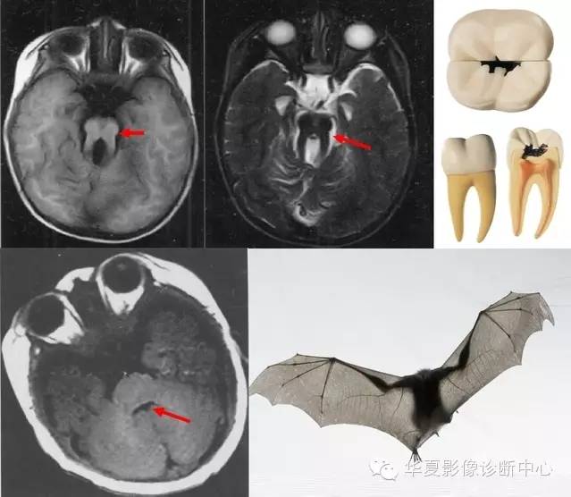 医学影像征象--解析汇集（神经系统部分）