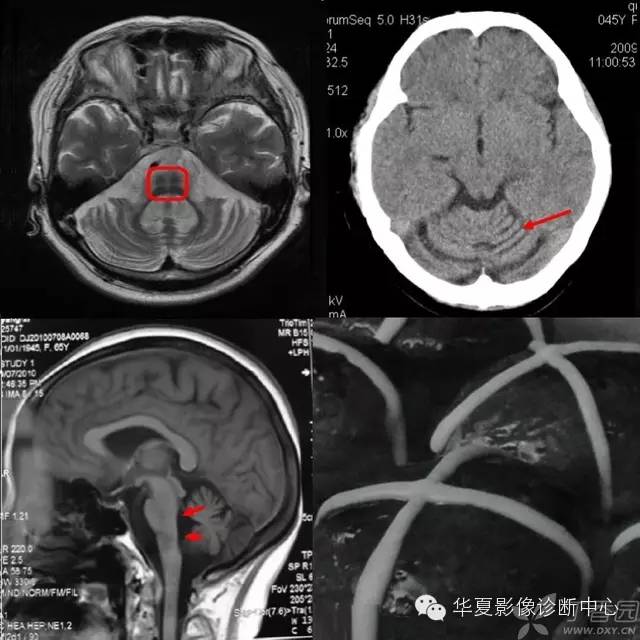 医学影像征象--解析汇集（神经系统部分）