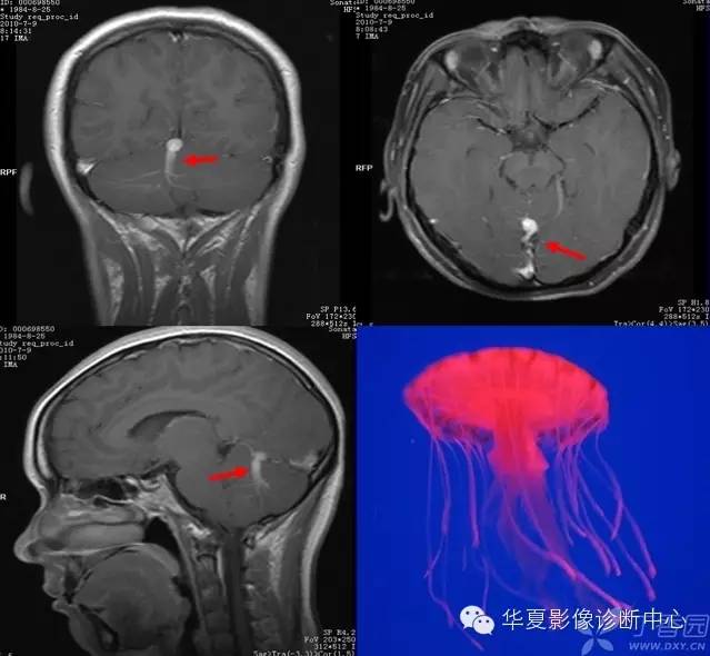 医学影像征象--解析汇集（神经系统部分）