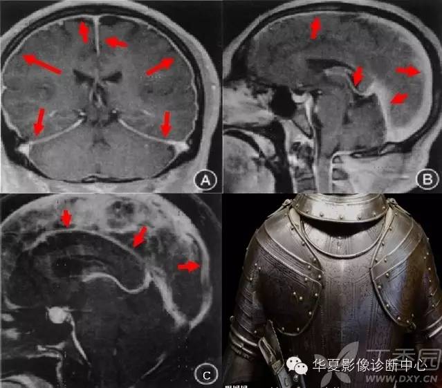 医学影像征象--解析汇集（神经系统部分）