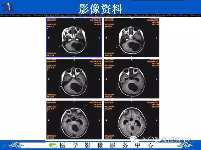 【病例】毛细胞型星形细胞瘤1例MR影像表现
