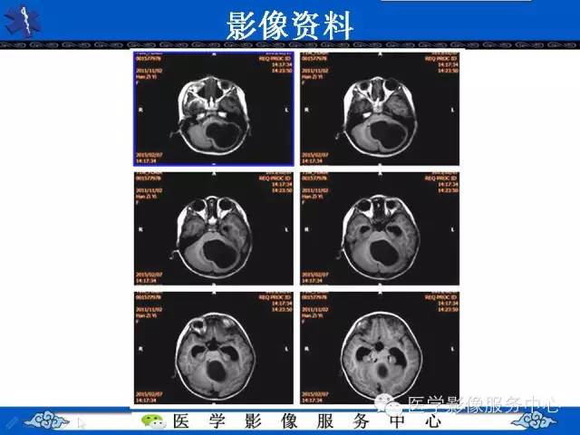 【病例】毛细胞型星形细胞瘤1例MR影像表现