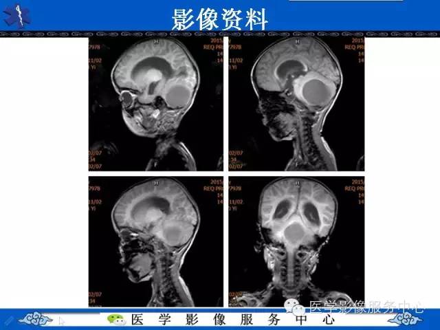 【病例】毛细胞型星形细胞瘤1例MR影像表现