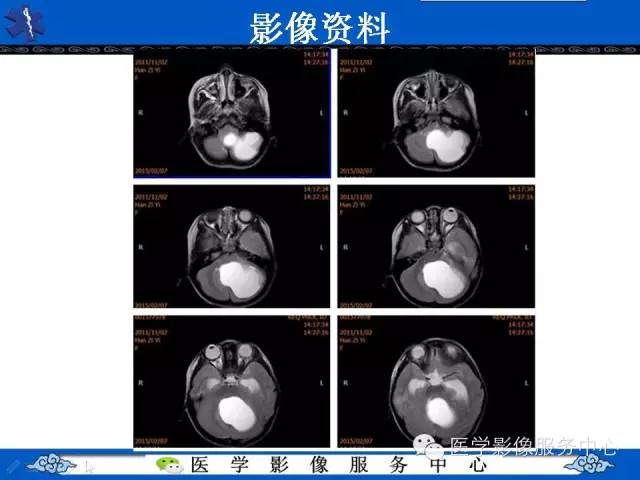 【病例】毛细胞型星形细胞瘤1例MR影像表现