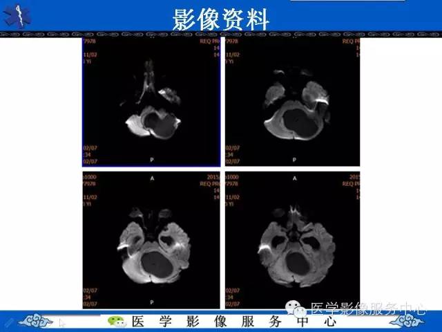 【病例】毛细胞型星形细胞瘤1例MR影像表现