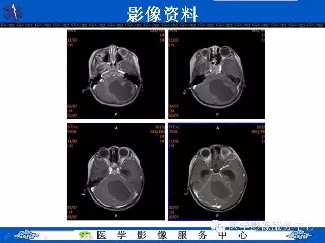 【病例】毛细胞型星形细胞瘤1例MR影像表现