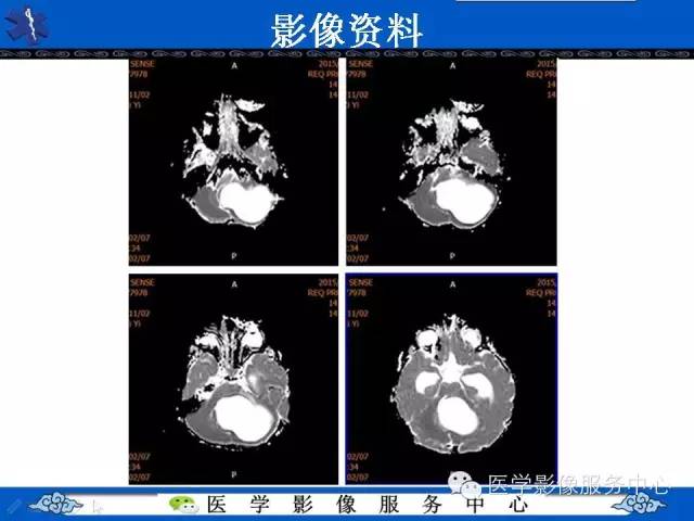 【病例】毛细胞型星形细胞瘤1例MR影像表现