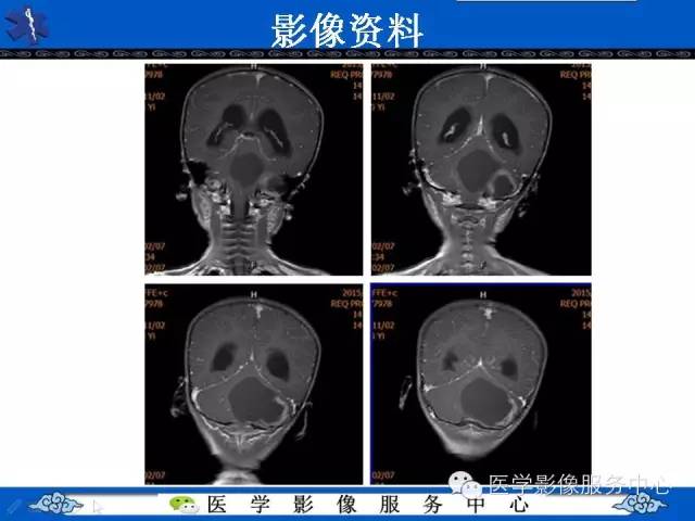 【病例】毛细胞型星形细胞瘤1例MR影像表现