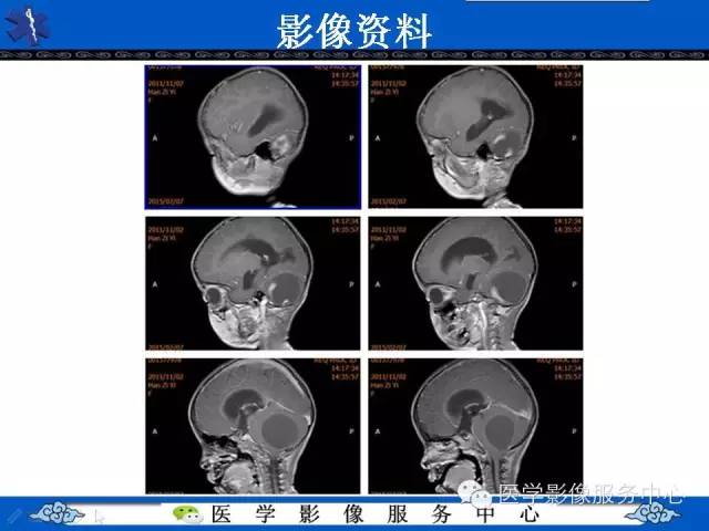 【病例】毛细胞型星形细胞瘤1例MR影像表现