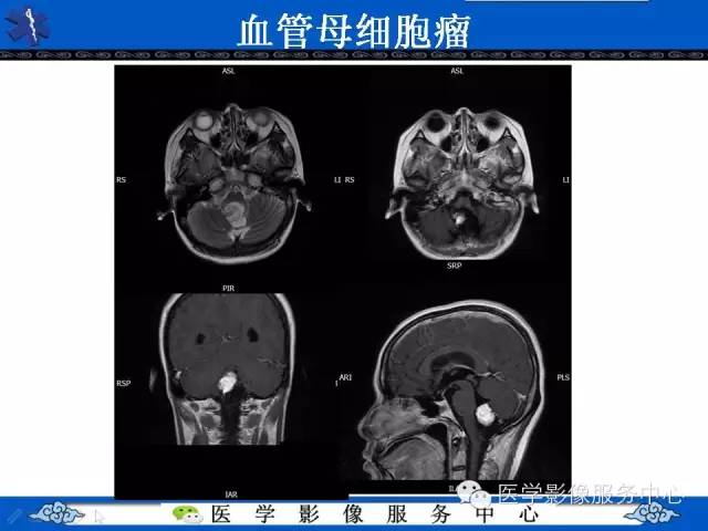 【病例】毛细胞型星形细胞瘤1例MR影像表现